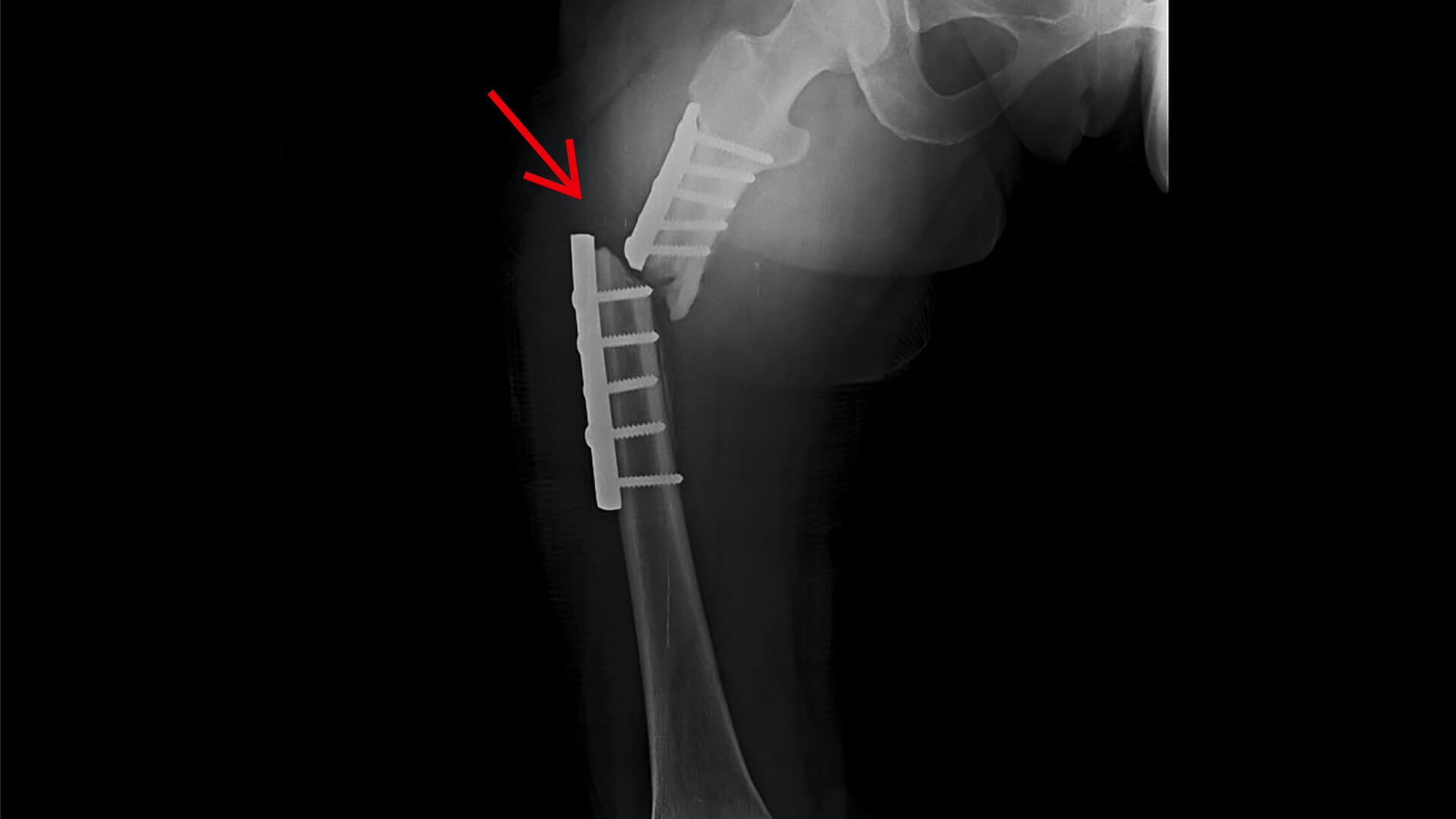 Medical Device Liability